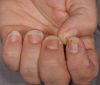 How to treat psoriasis on the nails?