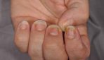 How to treat psoriasis on the nails?