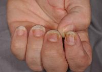 How to treat psoriasis on the nails?