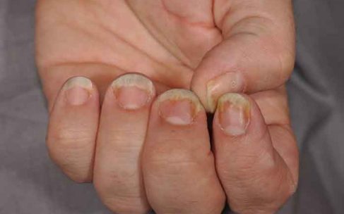 How to treat psoriasis on the nails?